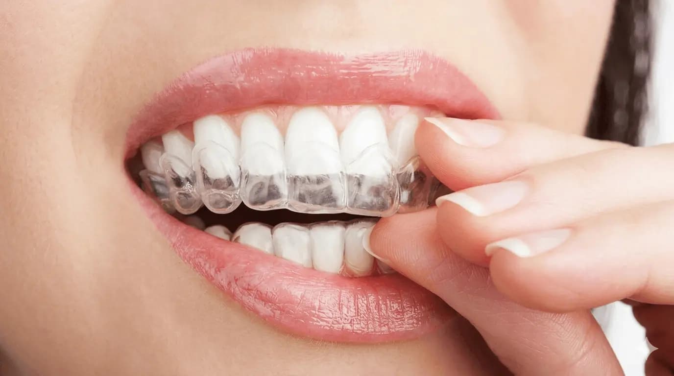 Niềng răng & Invisalign
