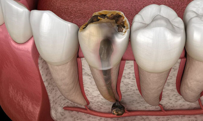Tủy răng bị viêm không kịp thời điều trị sẽ gây đau nhức dữ dội dẫn đến nhiều biến chứng
