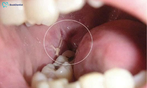 Trường hợp nhổ răng xong xuất hiện màng trắng sau khi nhổ răng nghĩa là dấu hiệu tốt