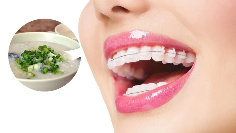 Đồ ăn cho người niềng răng cần chọn đồ ăn mềm, dễ nuốt