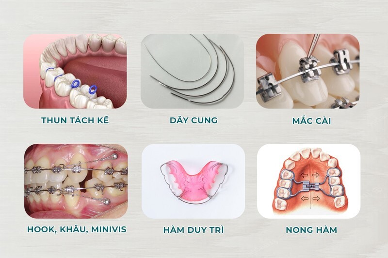 Tìm hiểu chi tiết về các dụng cụ niềng răng