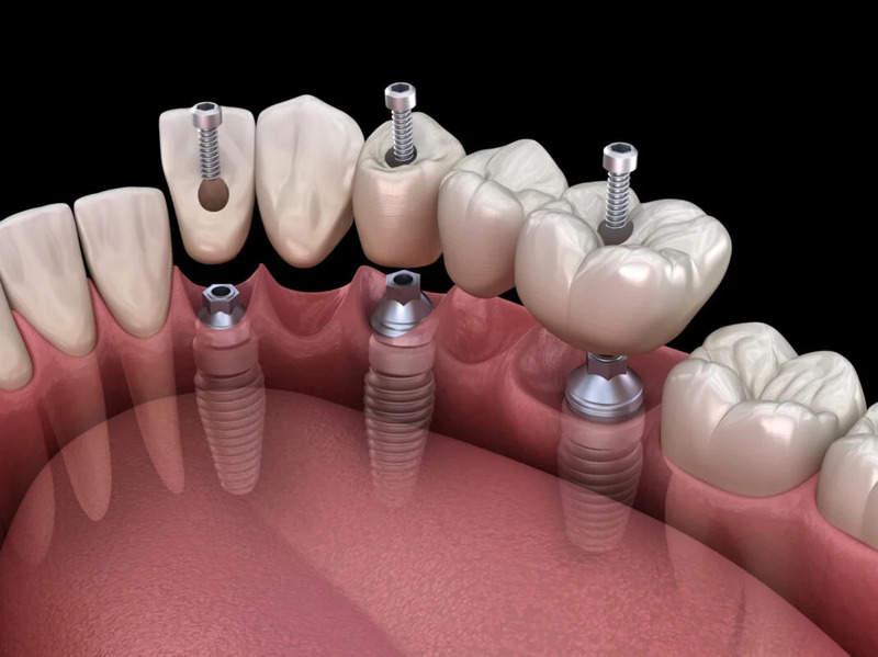 Một số lưu ý Implant bền và hiệu quả lâu dài
