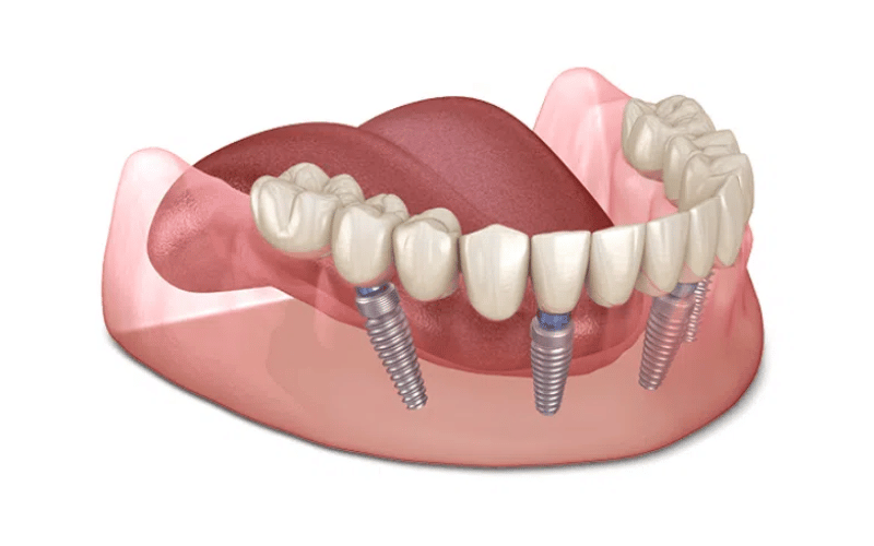 Lợi ích trồng răng Implant mang lại khả năng nhai như răng thật
