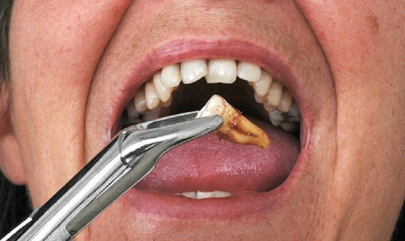 Cơ thể đang bị bệnh không nên nhổ răng