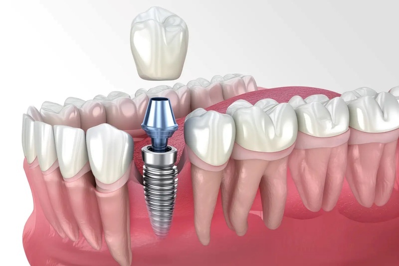 Cấy Implant là phương pháp phục hồi răng cấm tối ưu nhất.