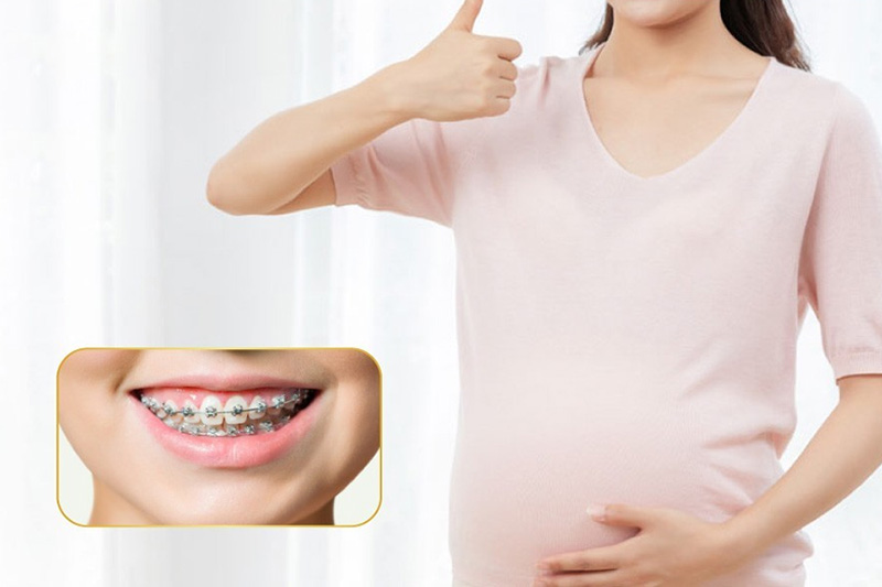 Một số lưu ý đang niềng răng khi mang thai.