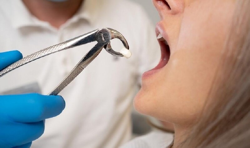 Cần chăm sóc sức khỏe răng miệng tốt sau nhổ răng.