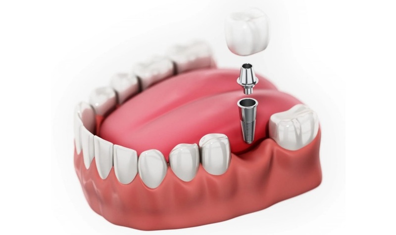 Cấy ghép Implant là lựa chọn tối ưu nhất để phục hồi răng hàm.