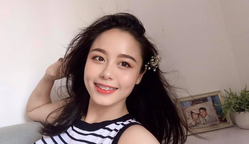 Niềng răng có được thi hoa hậu không? Hoàn toàn có thể tham gia thi được