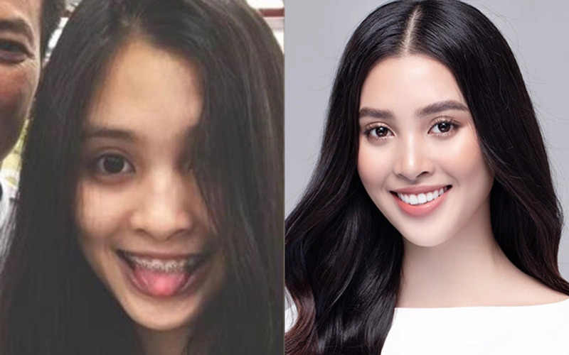 Nụ cười rạng rỡ, đều đẹp của Tiểu Vy sau niềng răng