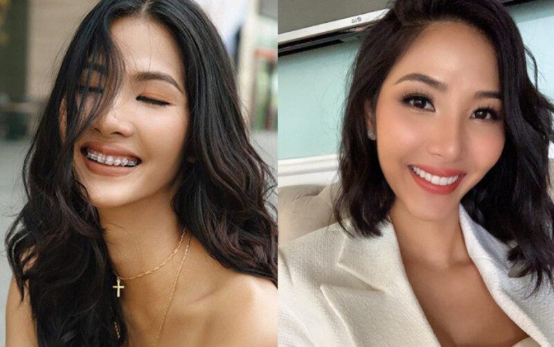 Á hậu Hoàng Thùy với nụ cười kim loại khi niềng răng