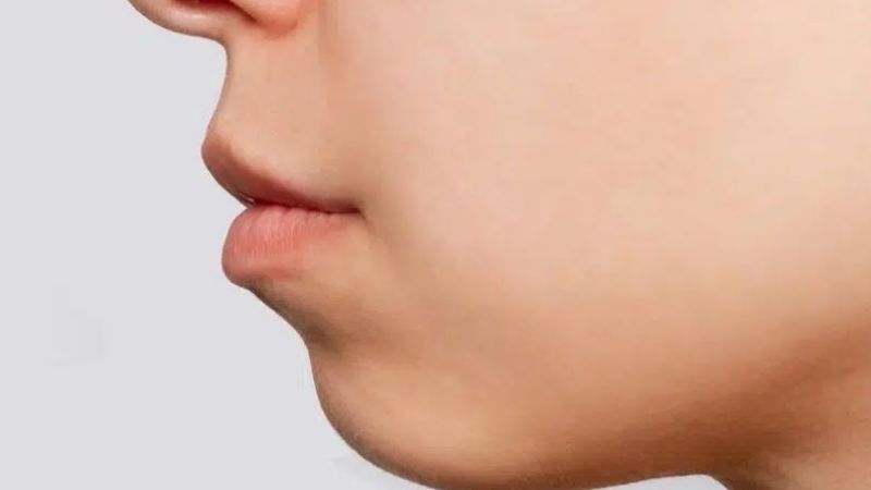 Trường hợp lẹm cằm do mất cân đối cung răng trên và dưới sẽ được cải thiện bằng niềng răng