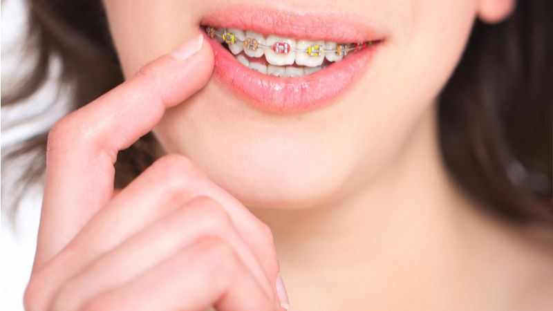 Niềng răng kết hợp minivis là lựa chọn tối ưu đối với những người bị lẹm cằm