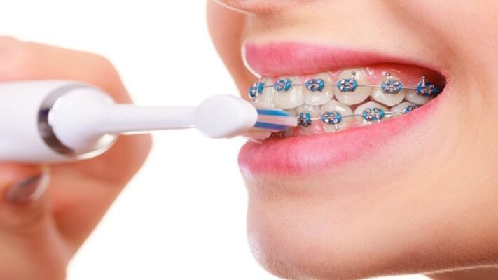 Niềng răng có nên dùng bàn chải điện không? Cách sử dụng an toàn
