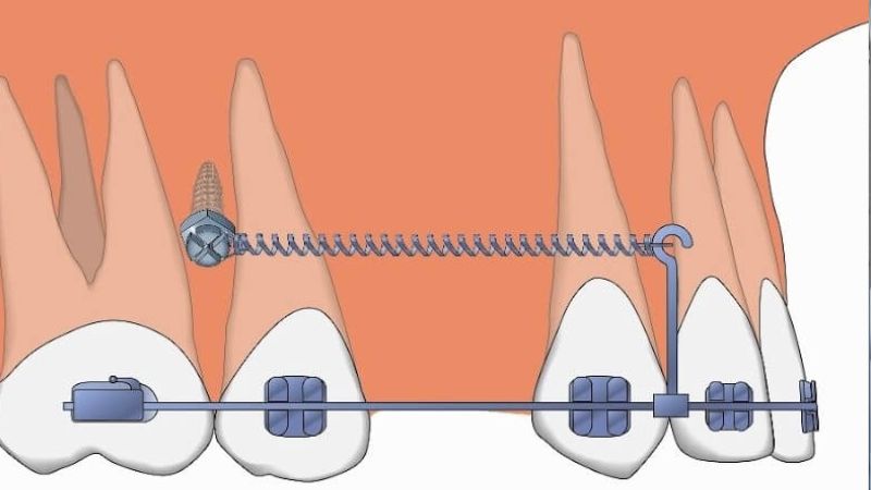 Khi gắn khâu hay đặt minivis chỉnh nha thì cần tiêm thuốc tê