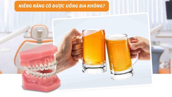 Giải đáp bác sĩ: Niềng răng có uống bia được không?
