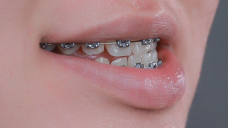 Răng móm có thể niềng để cải thiện thẩm mỹ