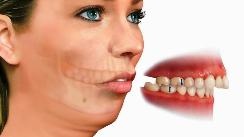 Niềng răng kết hợp phẫu thuật chỉnh hàm là phương pháp hiệu quả cho người bị móm