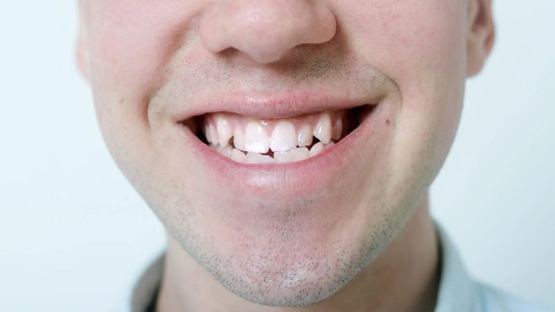 Ghi nhớ và khám đúng lịch hẹn từ bác sĩ chỉnh nha giúp duy trì kết quả