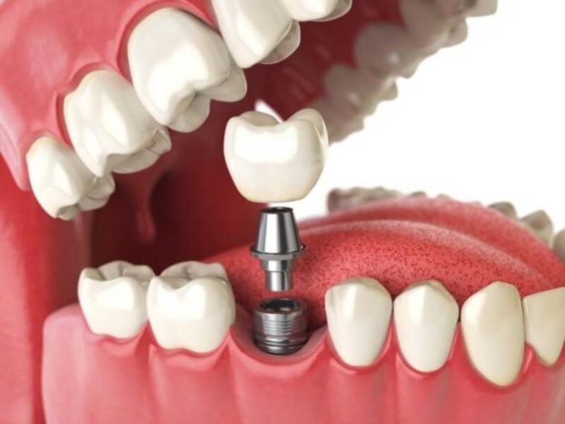Không nên niềng răng khi đã trồng implant cố định.