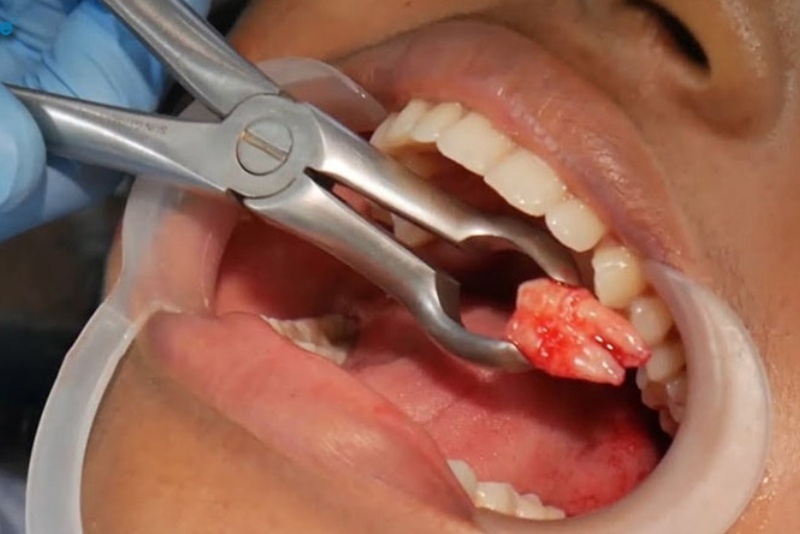 Kỹ thuật nhổ răng ảnh hưởng đến thời gian trồng răng sứ