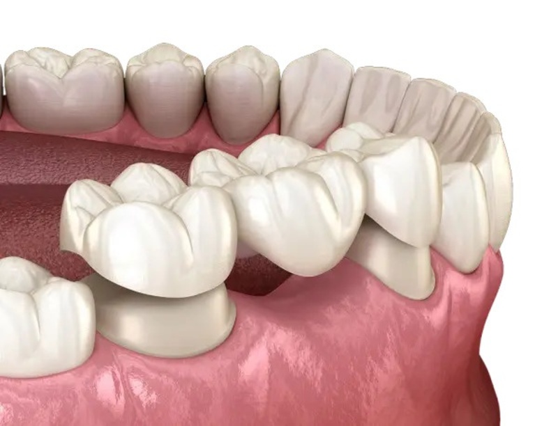 Trồng răng sứ sau nhổ răng tùy mức độ lành thương và phương pháp phục hình