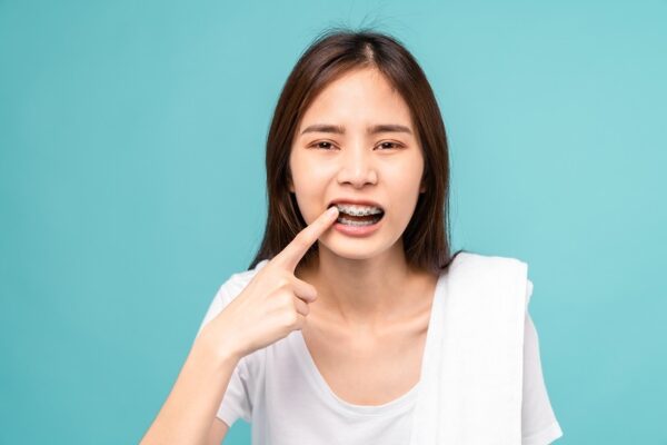 Niềng răng có ảnh hưởng đến phát âm không? Câu trả lời là có ảnh hưởng nhẹ.