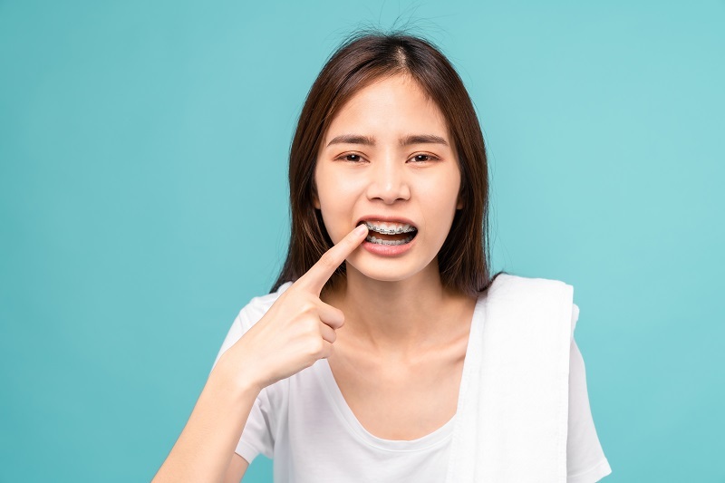 Niềng răng có ảnh hưởng đến phát âm không? Câu trả lời là có ảnh hưởng nhẹ.