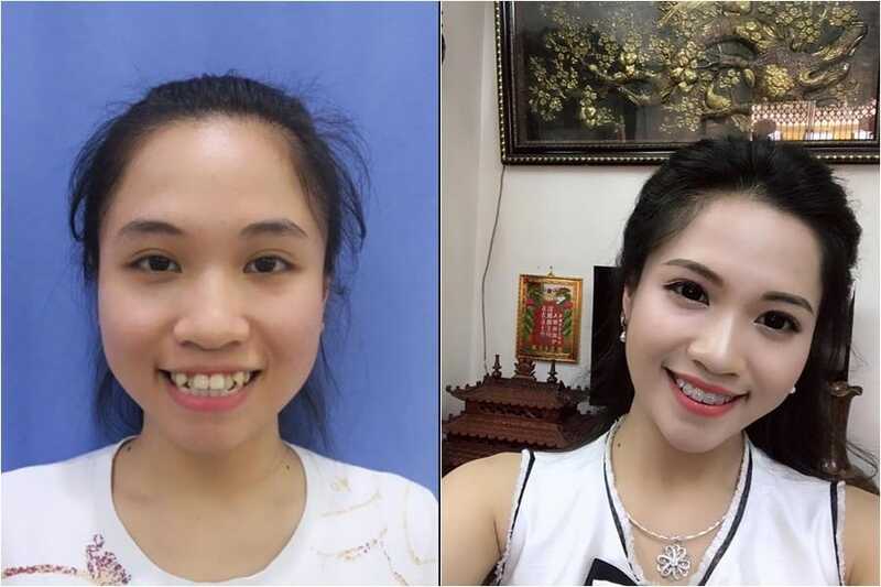 Kết quả niềng răng thực tế giúp gương mặt hài hòa hơn
