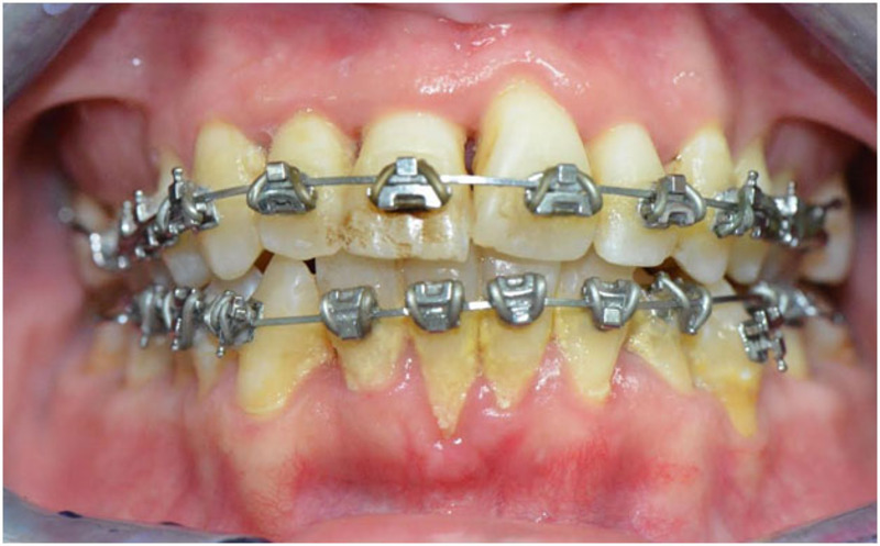 Nha chu yếu làm gia tăng nguy cơ tụt lợi khi niềng răng