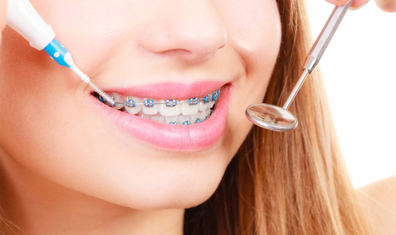 Cần vệ sinh răng miệng đúng cách giảm tối đa nguy cơ răng yếu khi niềng