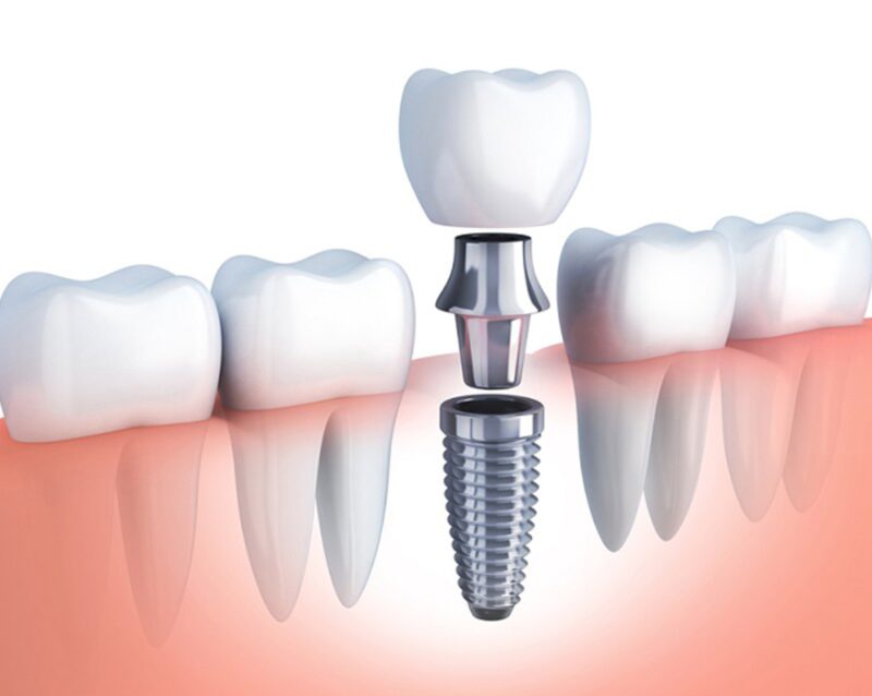 Kiểm soát đường huyết giúp trồng implant an toàn.