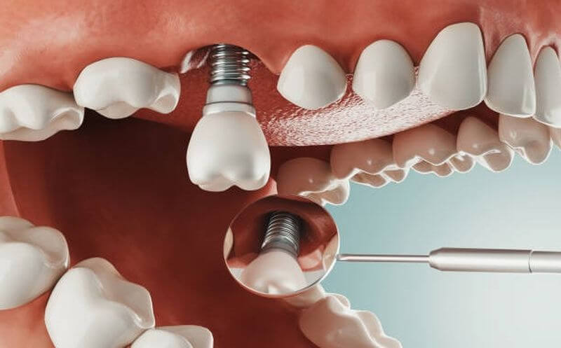 Một số lưu ý khi trồng implant an toàn, hiệu quả cho người tiểu đường