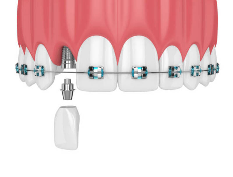 Niềng răng sau khi trồng implant phù hợp với số lượng implant đơn lẻ