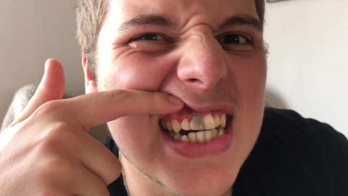 Người mắc viêm nha chu khiến chân răng sứ bị đen