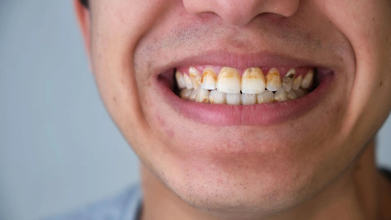 Làm sạch mảng bám, cao răng giúp phòng ngừa răng sứ bị đen chân răng