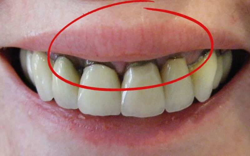 Răng sứ đổi màu chân răng do oxy hóa kim loại