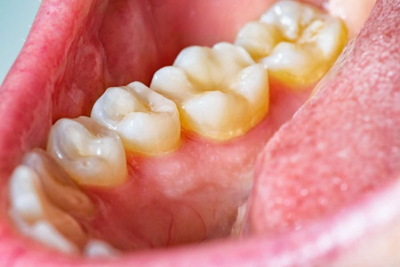 Niềng răng dễ tích tụ mảng bám nếu vệ sinh không kỹ