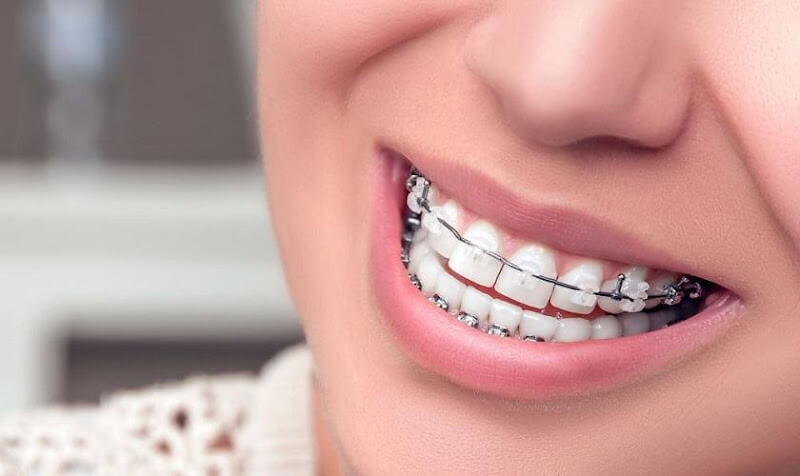 Hôn khi niềng răng không gây tổn thương răng