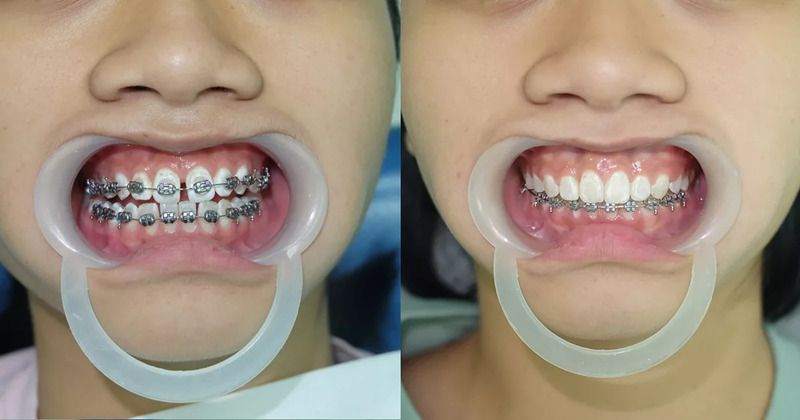 Bác sĩ chỉnh nha tận dụng khe thưa để dịch chuyển răng mà không nhổ