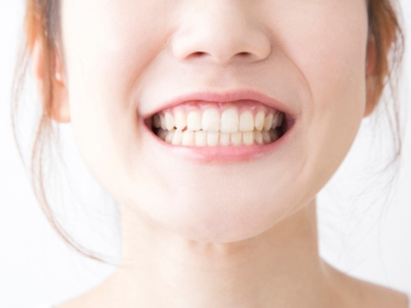 Niềng răng xong bị cười hở lợi: Có phải biến chứng nguy hiểm? Xác định nguyên nhân hở lợi để lựa chọn phương pháp điều trị phù hợp