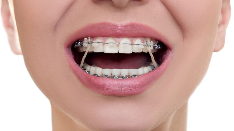 Nuốt 1–2 dây thun niềng răng thường không nguy hiểm