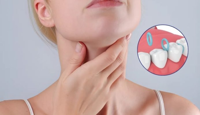 Nuốt dây thun niềng răng không gây nguy hiểm