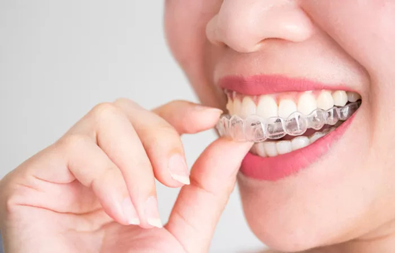 Hóp thái dương khi niềng răng: Nguyên nhân và cách khắc phục hiệu quả Niềng răng trong suốt Invisalign giúp ăn uống thoải mái hơn