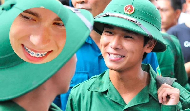 Niềng răng có đi nghĩa vụ không? Cập nhật quy định mới Niềng răng vẫn có thể phải đi nghĩa vụ quân sự