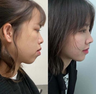 Góc nghiêng khuôn mặt thanh thoát hơn sau khi niềng răng