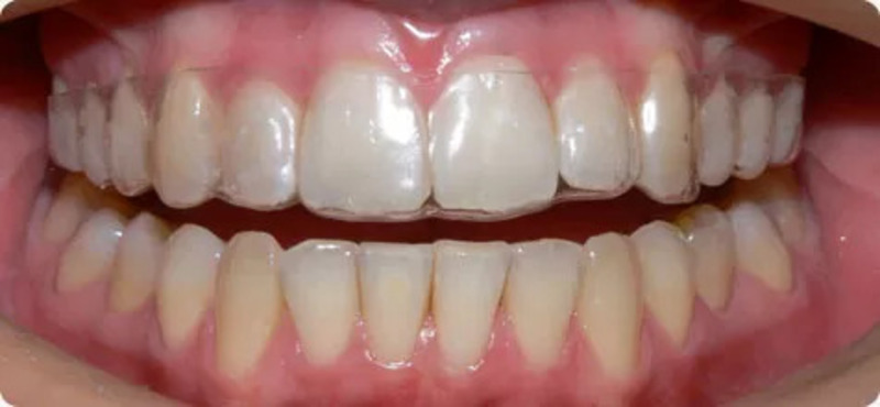 Sau khi niềng răng đeo hàm duy trì bao lâu? Bác sĩ giải đáp Hàm duy trì trong suốt giúp giữ kết quả chỉnh nha sau khi tháo niềng