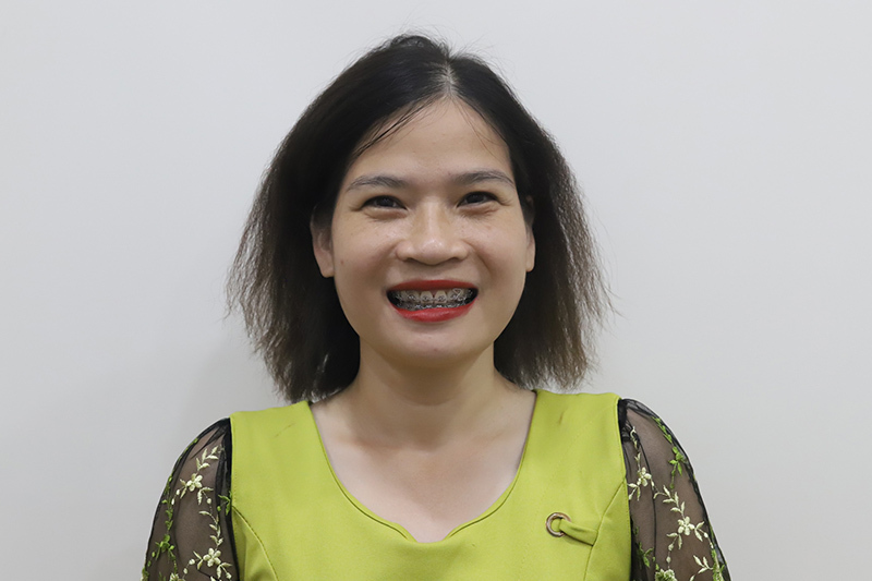 40 Tuổi vẫn có thể niềng răng khi xương hàm và răng còn khỏe