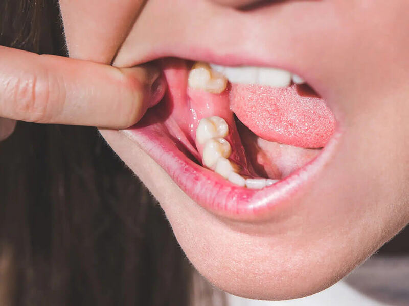 Mất 2 răng số 6 có thể làm kế hoạch niềng phức tạp hơn