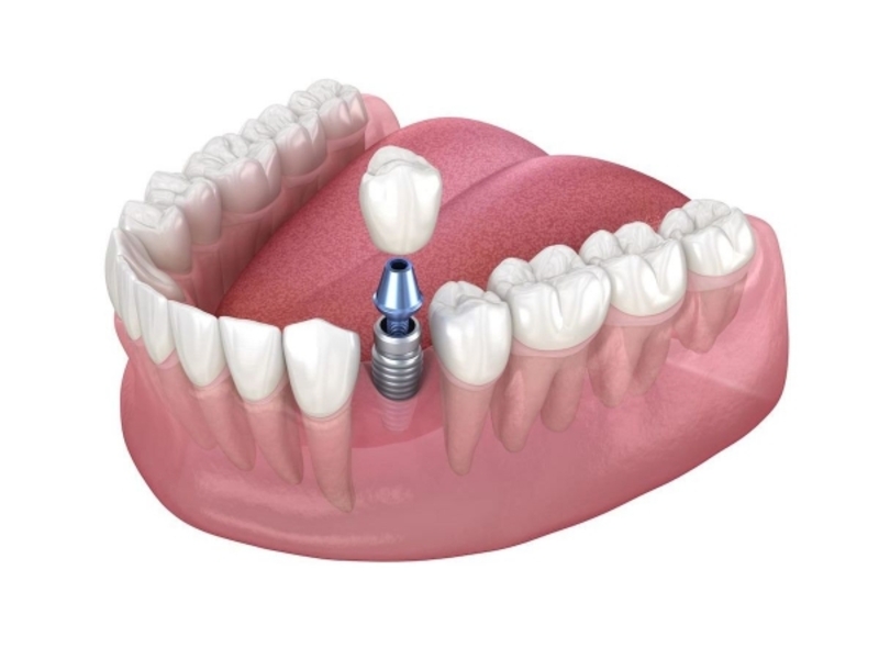 Giải pháp implant khi mất răng số 6 trước niềng răng